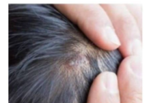 BUBULJICE NA GLAVI SU SVE ČEŠĆI PROBLEM: Ni slučajno ih ne istiskujte, evo zašto se javljaju I ŠTA TREBATE URADITI DA NESTANU