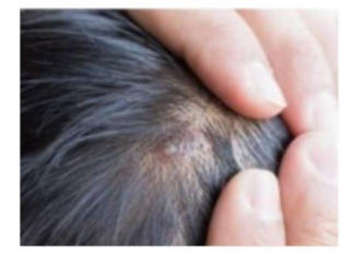 BUBULJICE NA GLAVI SU SVE ČEŠĆI PROBLEM: Ni slučajno ih ne istiskujte, evo zašto se javljaju I ŠTA TREBATE URADITI DA NESTANU