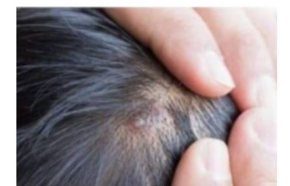 BUBULJICE NA GLAVI SU SVE ČEŠĆI PROBLEM: Ni slučajno ih ne istiskujte, evo zašto se javljaju I ŠTA TREBATE URADITI DA NESTANU