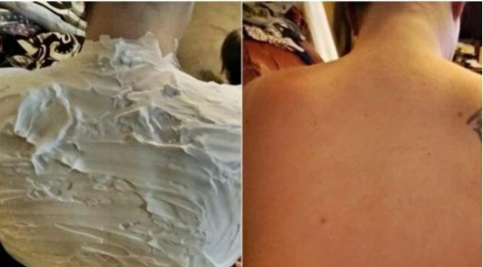 Izgorela je na suncu, a ovo ju je spasilo za 30 minuta: Svi to imamo u kući, a nije jogurt