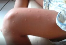 KOMARCI VAM PRAVE PAKAO OD ŽIVOTA? Samo isijecite OVO VOĆE na pola i ostavite u sobi, VIŠE IH NIKADA NEĆETE VIDJETI BLIZU!