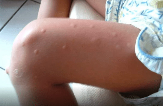 KOMARCI VAM PRAVE PAKAO OD ŽIVOTA? Samo isijecite OVO VOĆE na pola i ostavite u sobi, VIŠE IH NIKADA NEĆETE VIDJETI BLIZU!