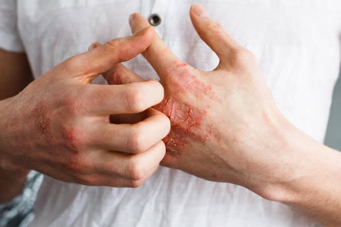 Umor, svrab, VISOK KRVNI PRITISAK, BOL U LEĐIMA – Ova bolest je ”TIHI UBICA”, obratite pažnju ako imate neke od ovih simptoma - featured image Umor, svrab, VISOK KRVNI PRITISAK, BOL U LEĐIMA – Ova bolest je ”TIHI UBICA”, obratite pažnju ako imate neke od ovih simptoma - featured image