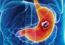 5 ranih simptoma raka želuca: Tumor može da raste godinama, a svi pacijenti prvo osjete ovo 5 ranih simptoma raka želuca: Tumor može da raste godinama, a svi pacijenti prvo osjete ovo - featured image