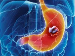 5 ranih simptoma raka želuca: Tumor može da raste godinama, a svi pacijenti prvo osjete ovo 5 ranih simptoma raka želuca: Tumor može da raste godinama, a svi pacijenti prvo osjete ovo - featured image