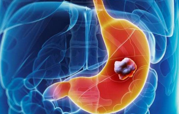 5 ranih simptoma raka želuca: Tumor može da raste godinama, a svi pacijenti prvo osjete ovo 5 ranih simptoma raka želuca: Tumor može da raste godinama, a svi pacijenti prvo osjete ovo - featured image
