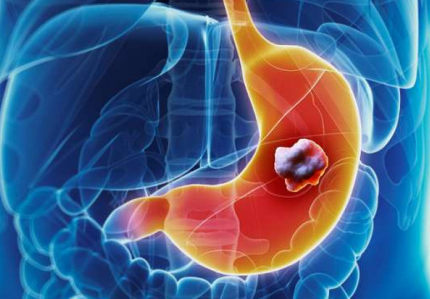 5 ranih simptoma raka želuca: Tumor može da raste godinama, a svi pacijenti prvo osjete ovo - featured image